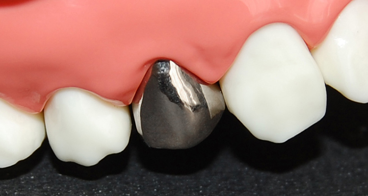 奥歯の被せ物（クラウン）金銀パラジウム合金