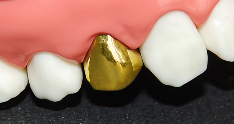 奥歯の被せ物（クラウン） ゴールド